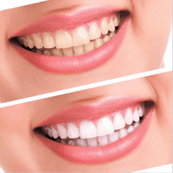 [3-Pack] White Bright - Now Teeth Whitening Changes Forever